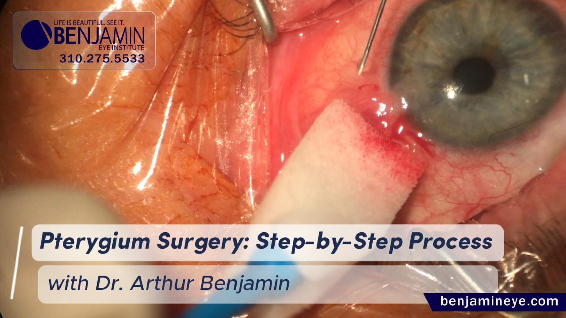 No-Stitch Pterygium Surgery with Amniotic Graft