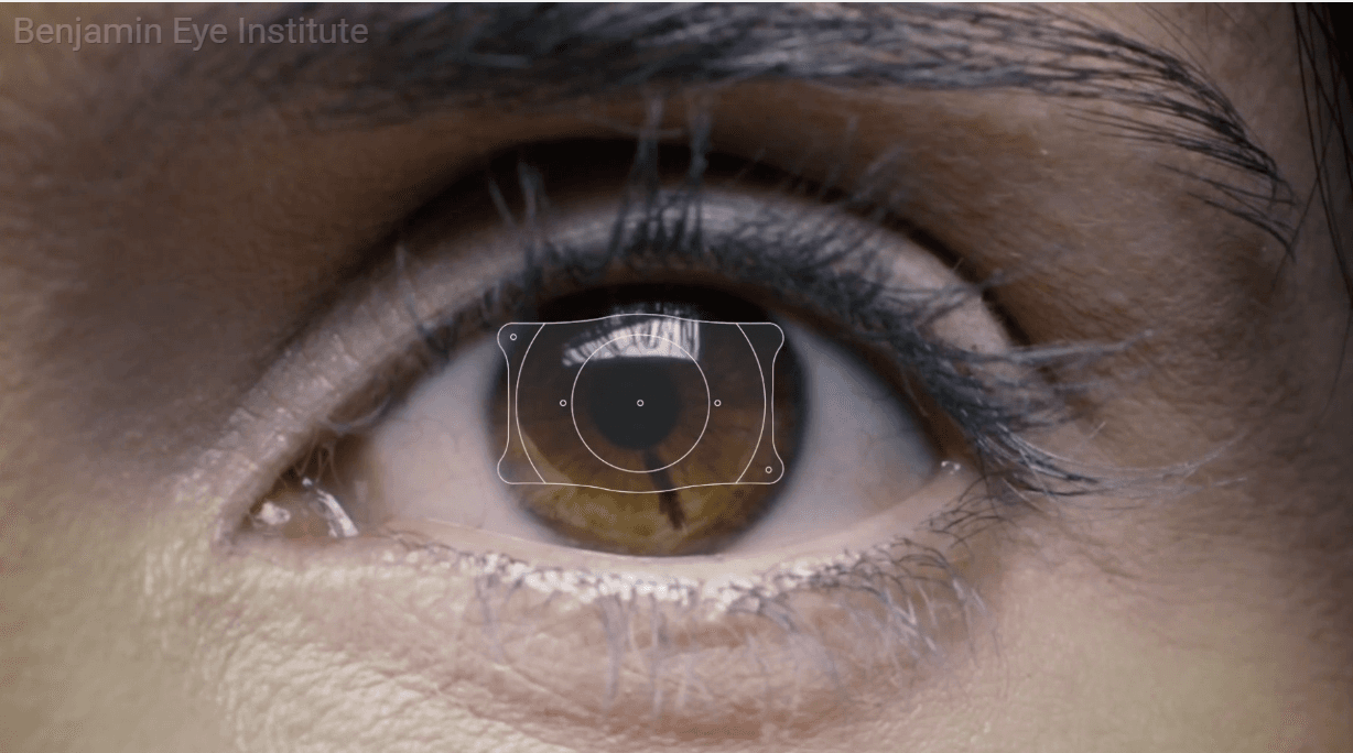 Beyond LASIK: The EVO ICL Difference