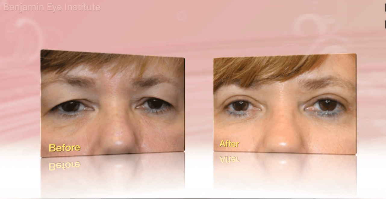 Blefaroplastia: cirugía de párpados con el Dr. Arthur Benjamin en Los Ángeles