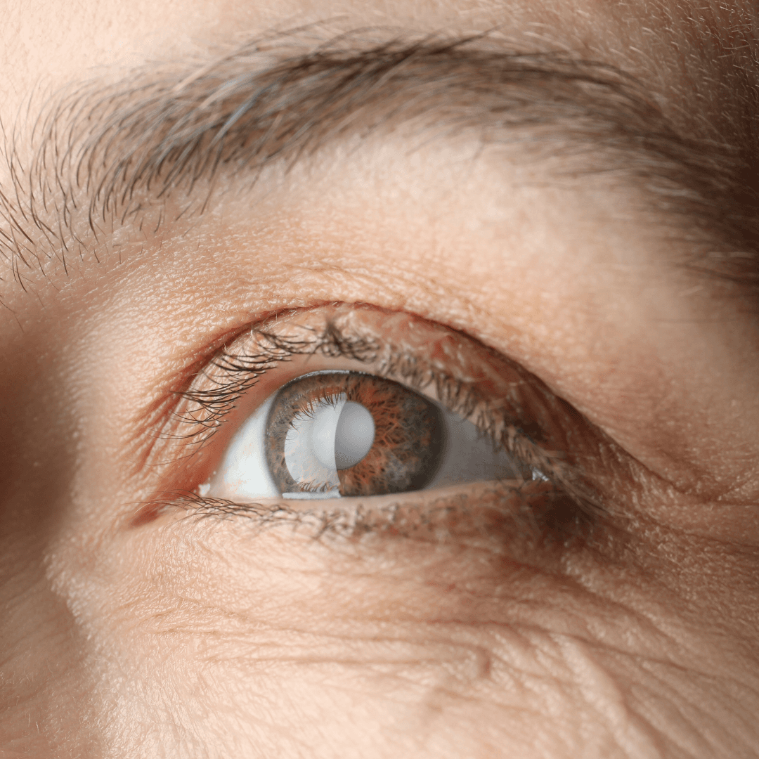 Cataract Surgery: Myths vs. Facts