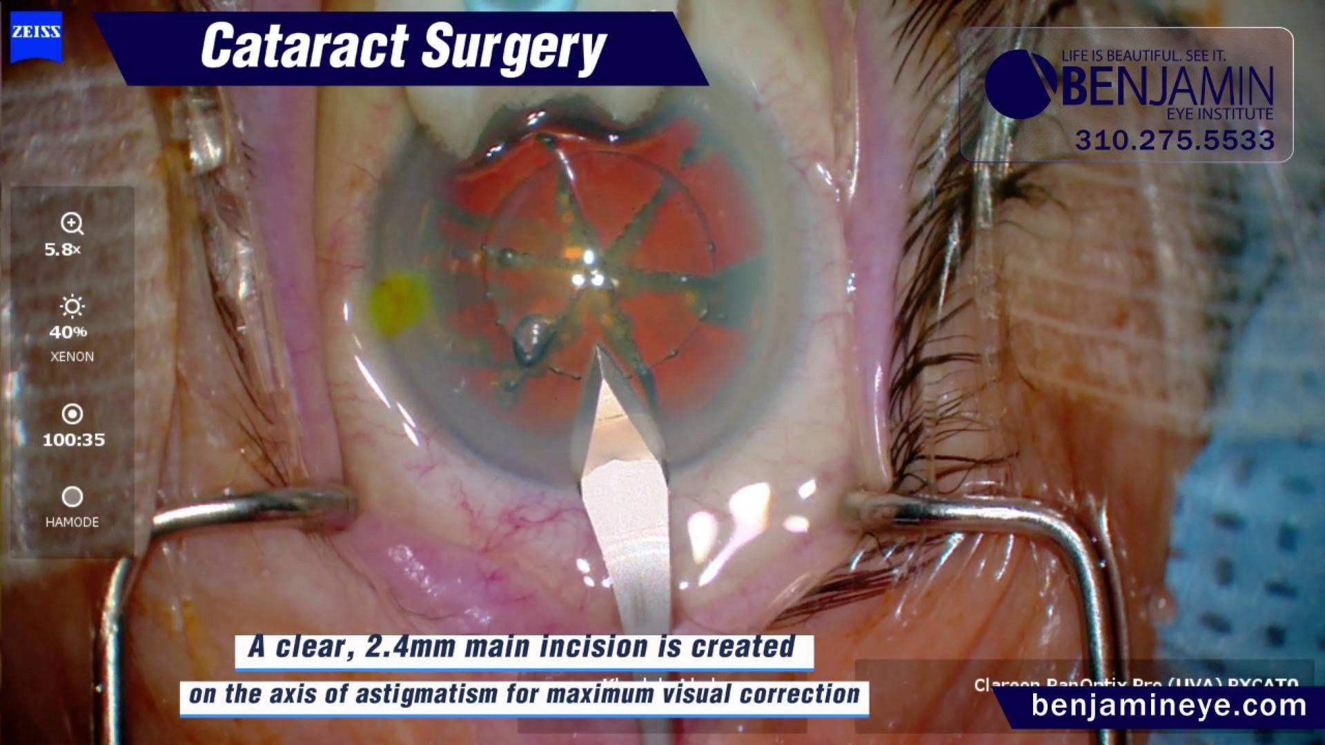 Cataract Surgery with OMNI MIGS: restoring vision while protecting eye health