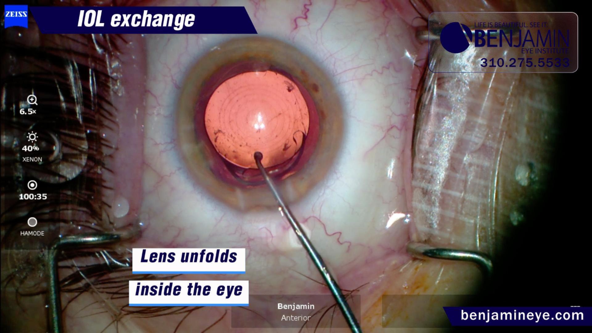 IOL Exchange Surgery: When a Lens Implant Needs to Be Removed and Replaced