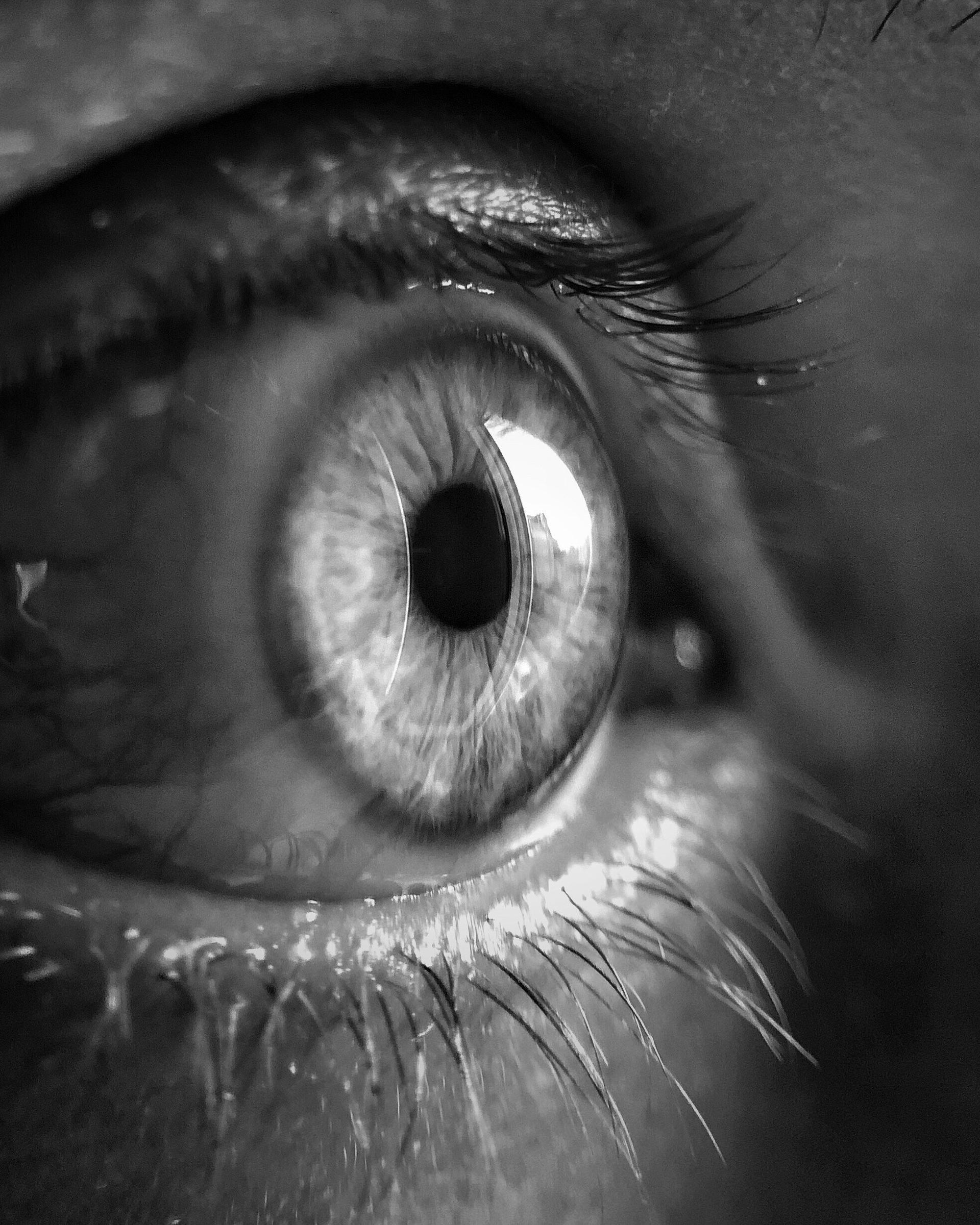 ВАМ КОГДА-ТО СДЕЛАЛИ LASIK, А ТЕПЕРЬ – КАТАРАКТА? (1)
