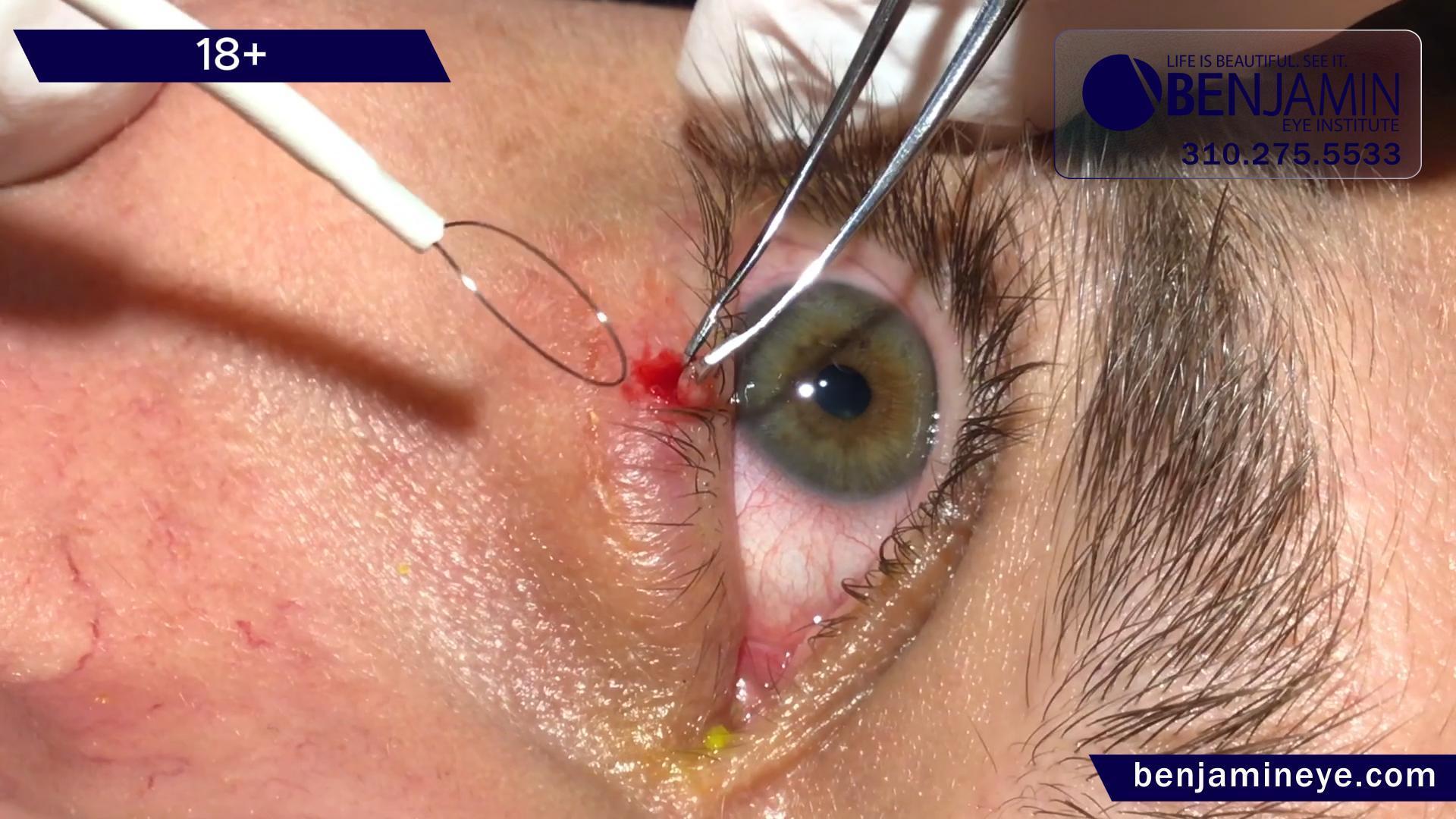 Masterful Precision: Dr. Benjamin’s Approach to Cystic Eyelid Lesion Removal