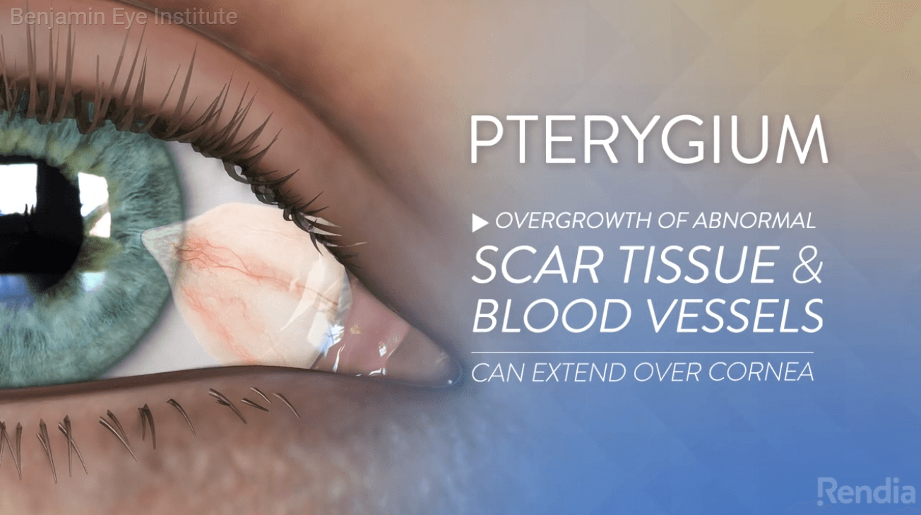 Pterygium Removal Recovery Guide: Post-Operative Care Instructions