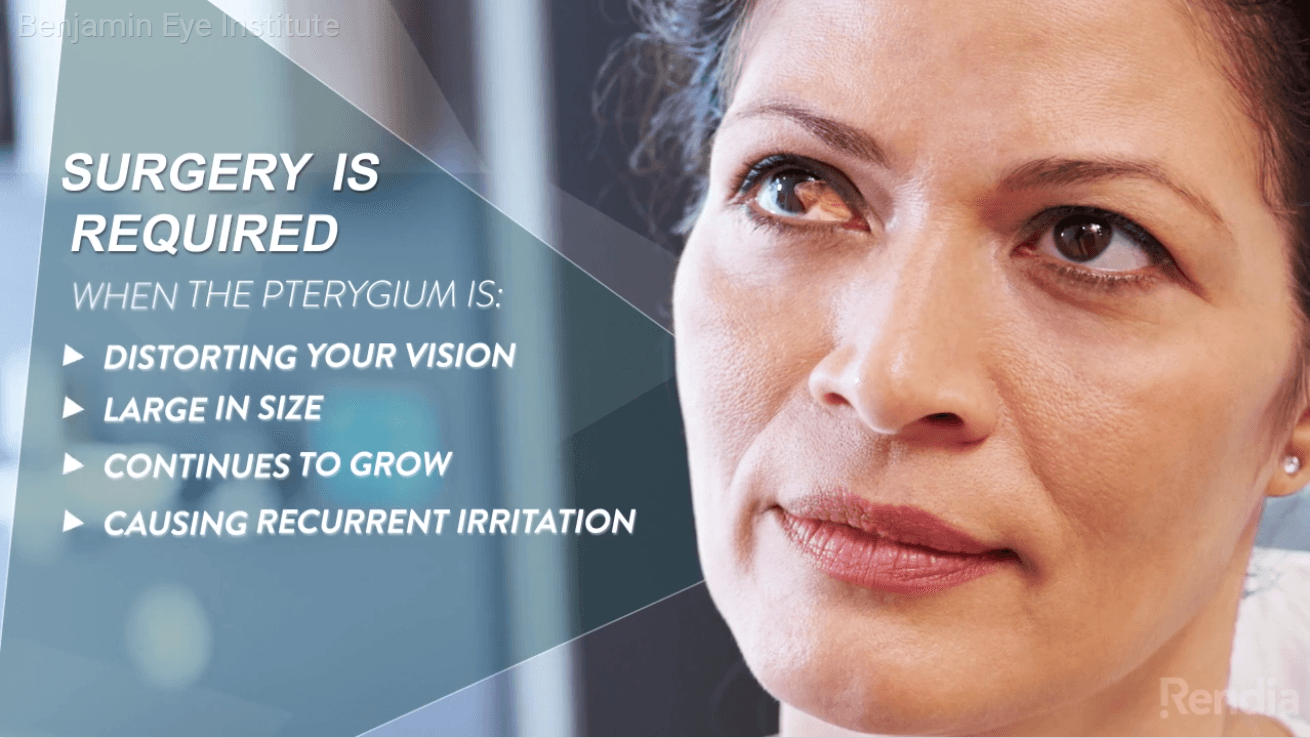 That Red Growth on Your Eye? Pterygium Surgery in Los Angeles Explained