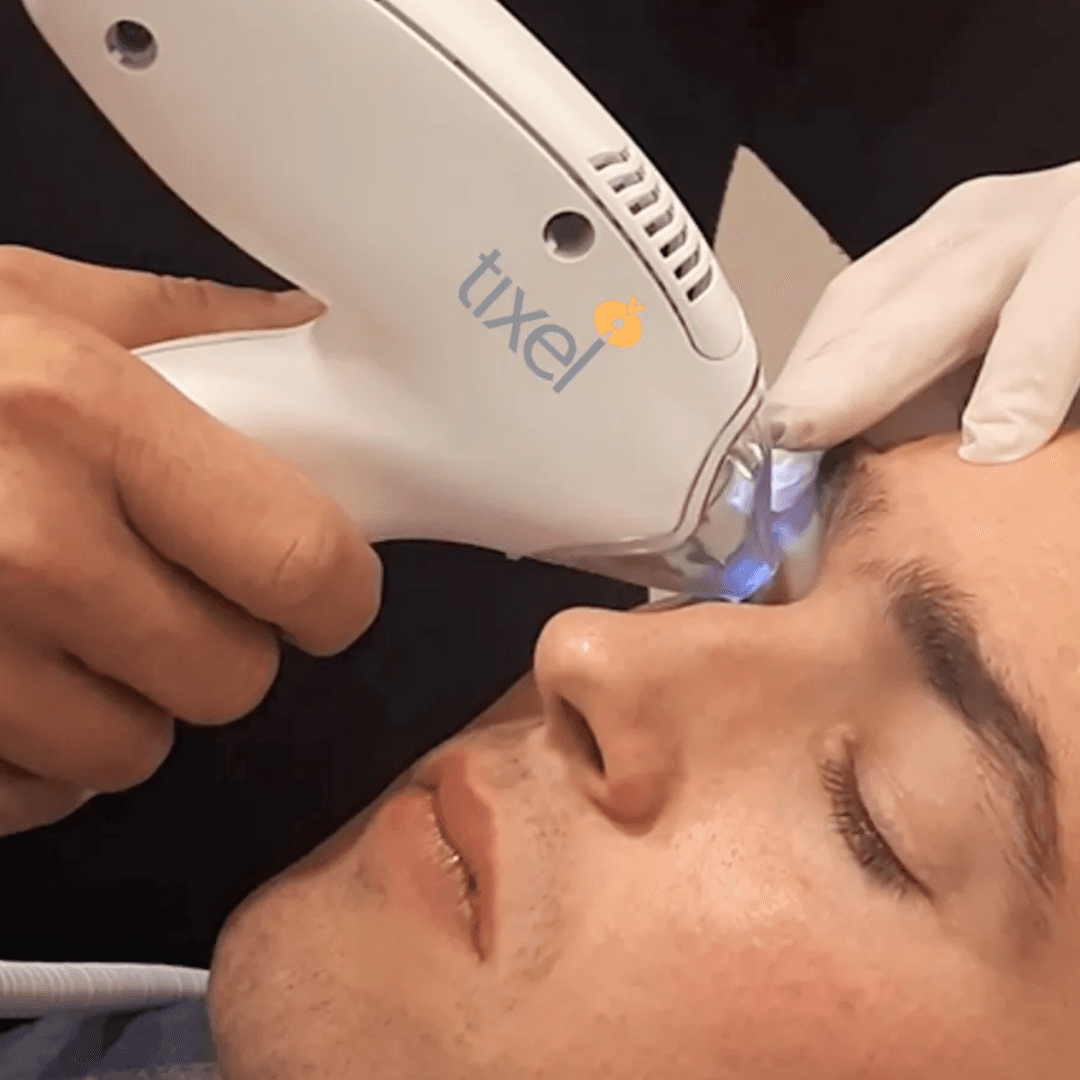 Tixel: The Newest Breakthrough in Dry Eye Treatment