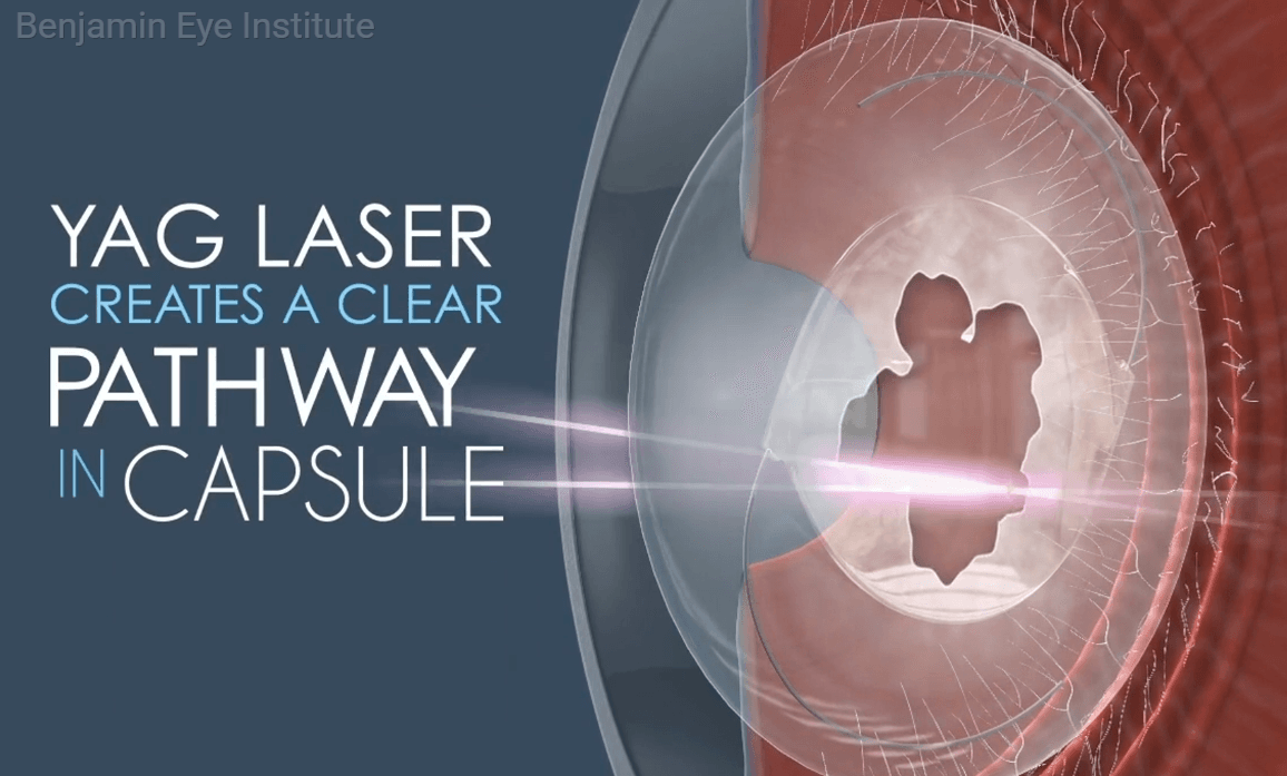 YAG Laser Capsulotomy: Clearer Vision After Cataract Surgery